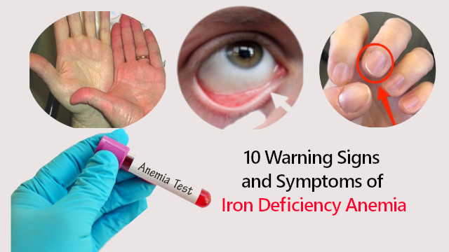 Warning Signs And Symptoms Of Iron Deficiency Anemia