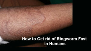 how do you get rid of ringworm ointment