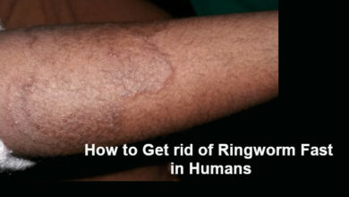 How to Get rid of Ringworm Fast in Humans at Home
