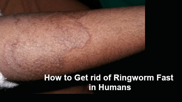 How To Get Rid Of Ringworm Fast In Humans At Home