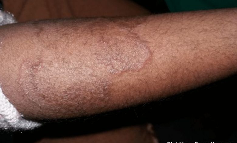 How to Get rid of Ringworm Fast and Forever