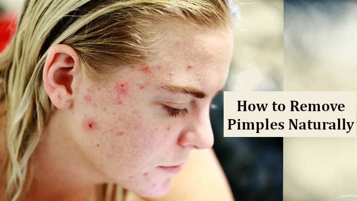 How to Remove Pimples Naturally