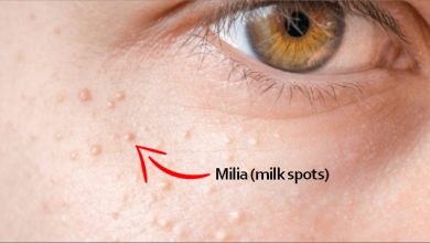 how to get rid of milia on face home remedies