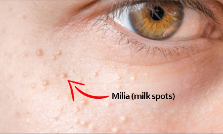 how to get rid of milia on face home remedies