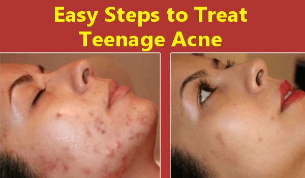 Treat Teenage Acne At Home