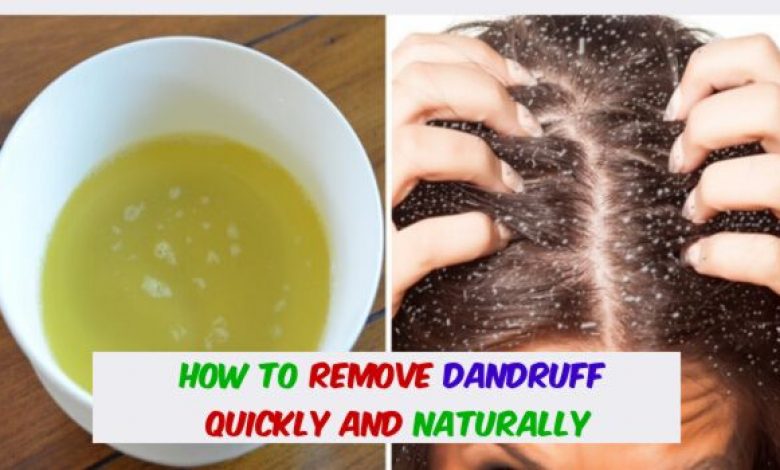 How To Remove Dandruff Quickly And Naturally