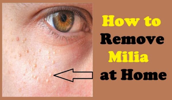 how-to-get-rid-of-milia-at-home-easily-right-home-remedies