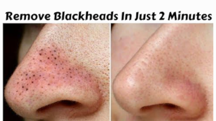 How to Remove Blackheads and Whiteheads
