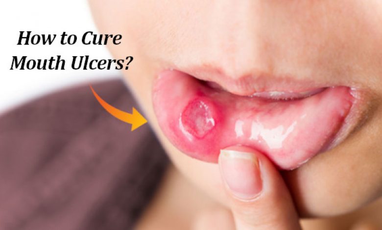 How to Cure Mouth Ulcers