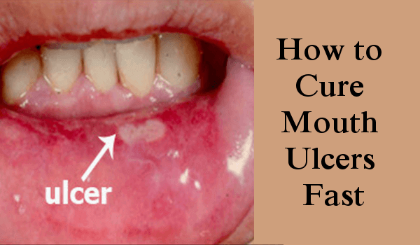 how-to-get-rid-of-mouth-ulcers-fast-naturally-printable-templates