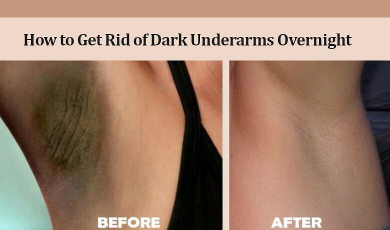 How to Get Rid of Dark Underarms