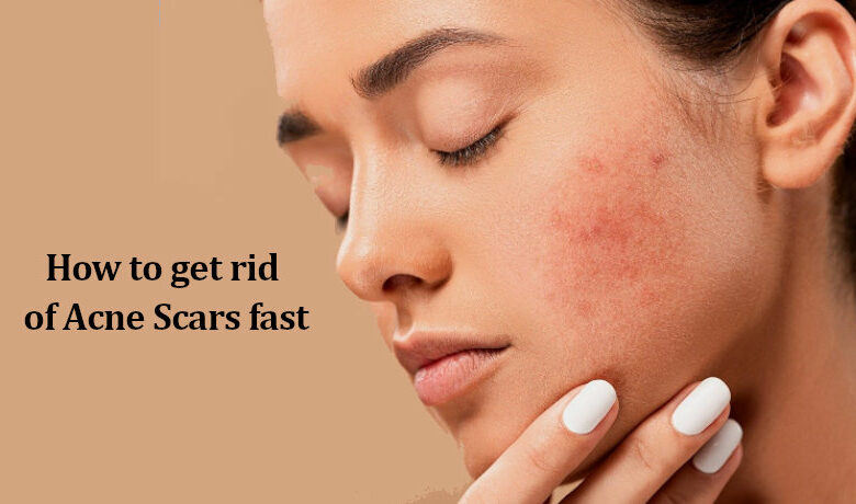 How to get rid of Acne Scars fast