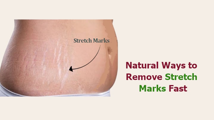 Natural Ways to Remove Stretch Marks