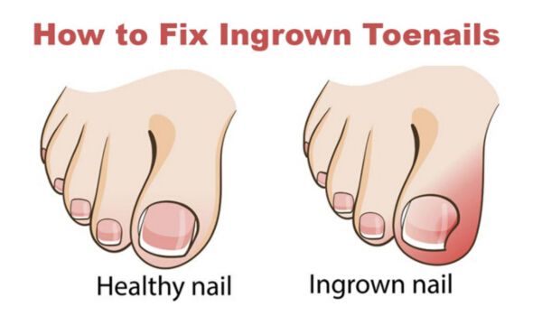 How to Get Rid of Ingrown Toenails