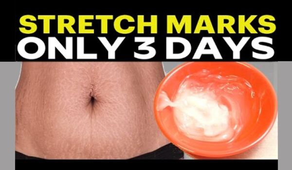 Stretch Marks Removal: 10 Best Home Remedies for Stretch Marks