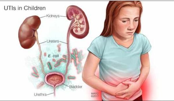 How to Treat Urinary Tract Infections (UTI)