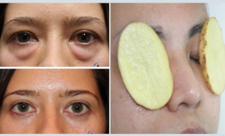 eye-bags-causes-how-to-remove-eye-bags-permanently