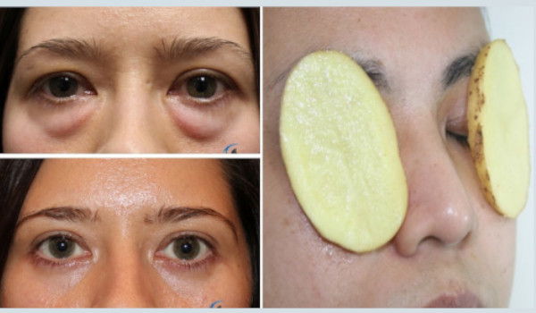 eye-bags-causes-how-to-remove-eye-bags-permanently