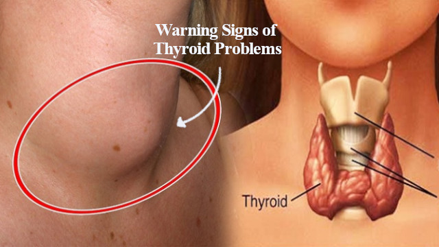 what are early warning signs of thyroid problems in females