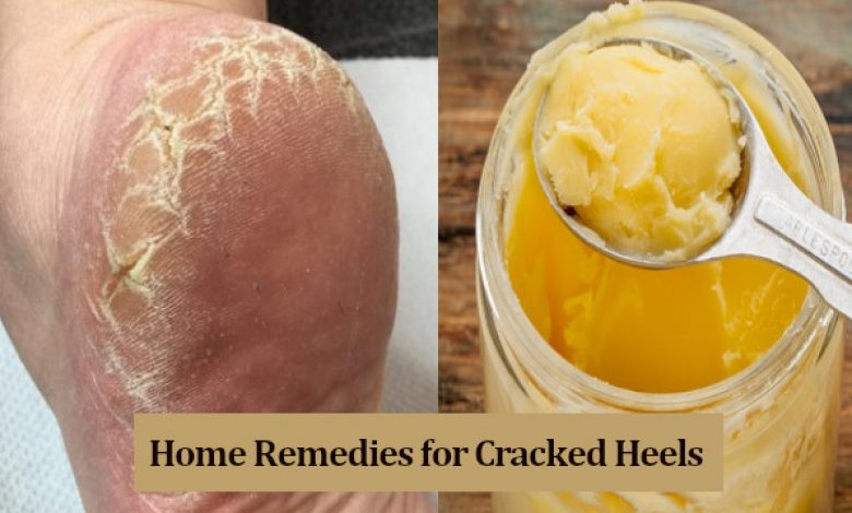 10-best-and-effective-home-remedies-for-cracked-heels