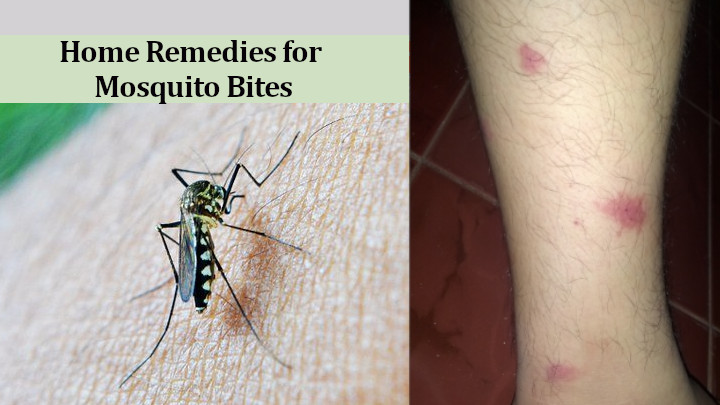 Home Remedies for Mosquito Bites