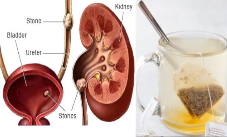 Without Surgery How to Pass a Kidney Stone Forever in 24 hours