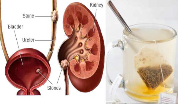 Without Surgery How to Pass a Kidney Stone Forever in 24 hours
