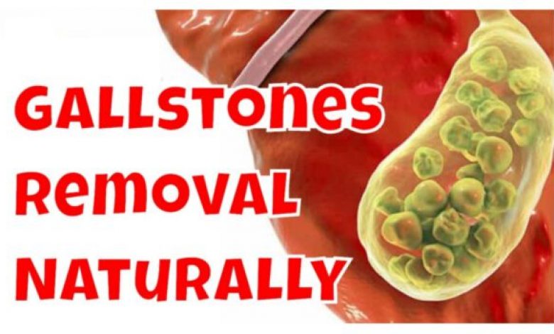 Gall Bladder Stone Removal Without Surgery In 7 Days