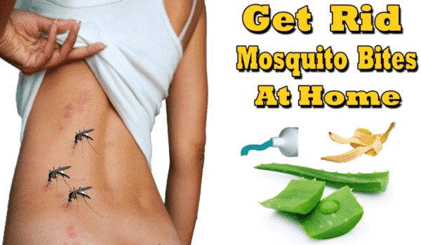 9 Home Remedies for Mosquito BitesStop Itching Fast