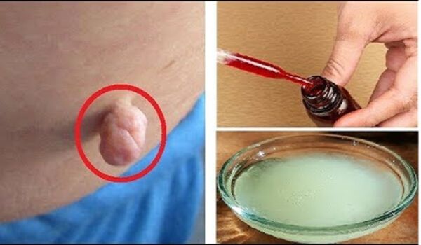 How to Get Rid of Skin Tags