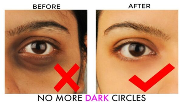 How to Remove Dark Circles in 2 Days