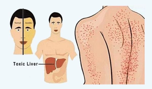 Everyday habit that damage your kidney