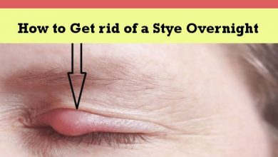 How to Get rid of a Stye Overnight