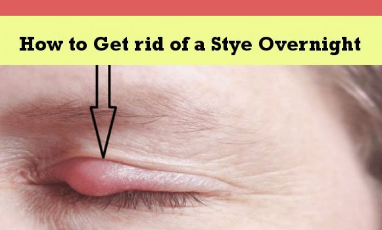 How to Get rid of a Stye Overnight