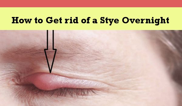 How to Get rid of a Stye Overnight
