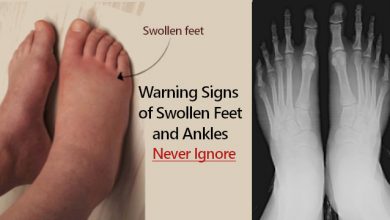 Swollen Feet and Ankles Causes in Men and Women