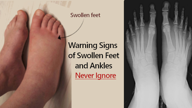 Swollen Feet and Ankles Causes in Men and Women