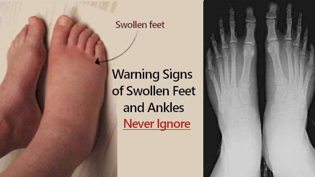 Swollen Feet And Ankles Causes In Men And Women