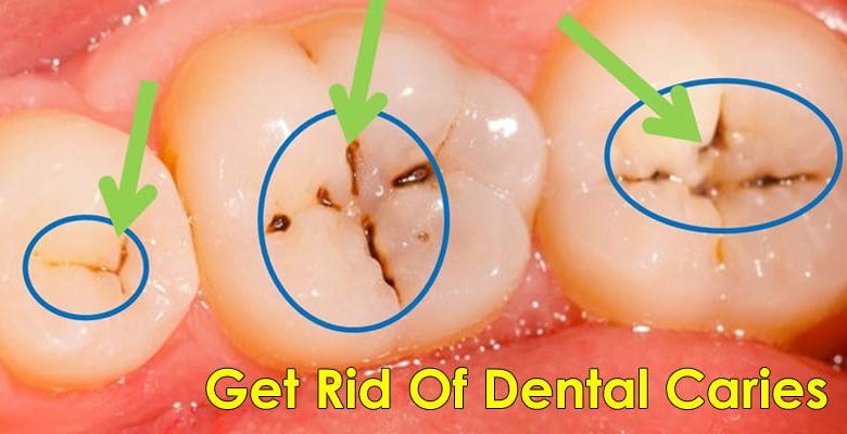How to Heal Severe Tooth Decay