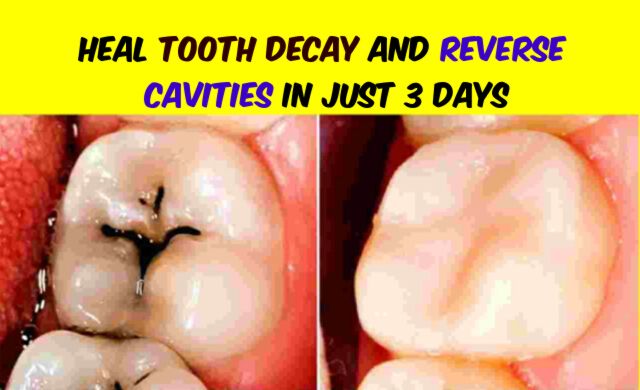 How to Heal Tooth Decay and Reverse Cavities In Just 3 Days