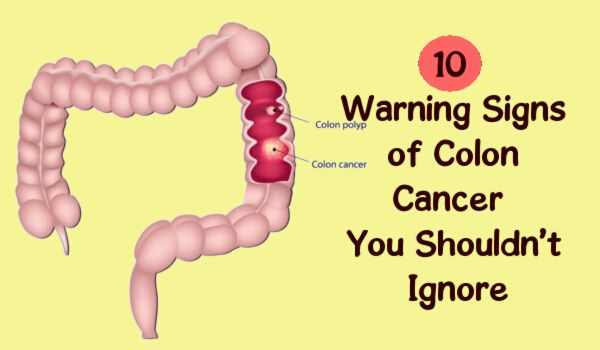 10 Warning Signs Of Colon Cancer You Shouldnt Ignore