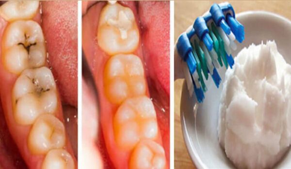 How to Heal Tooth Decay and Reverse Cavities