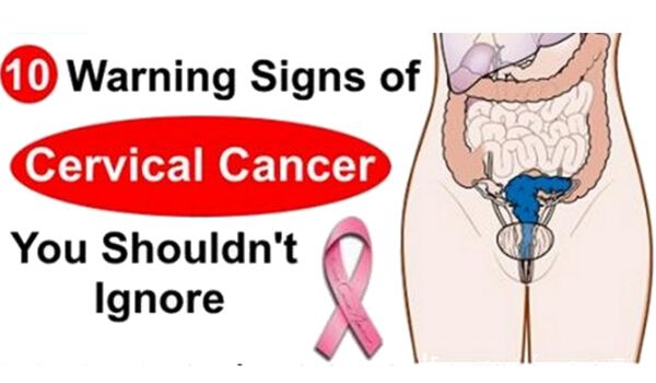 10 Warning Signs of Cervical Cancer You Should Not Ignore