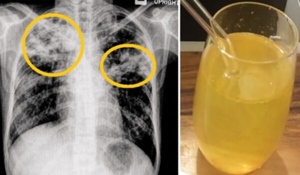 Say Goodbye To Cough Phlegm, Flu, and Clean The Lungs Forever With This Old Recipe!
