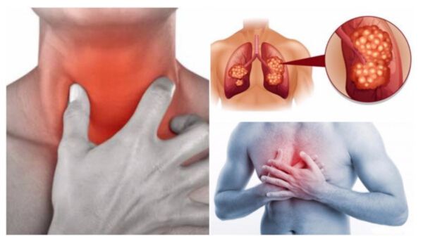 10 Early Warning Signs of Lung Cancer You Need to Know!