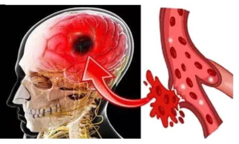 Warning Signs of a Stroke in Men and Women