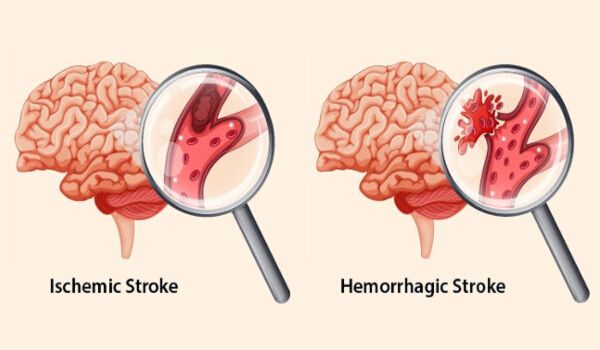 7 Early Warning Signs of Stroke Everyone Should Know