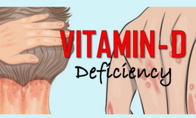 12 Serious Vitamin D Deficiency Symptoms You Need To Know   Vd 1 780x470 