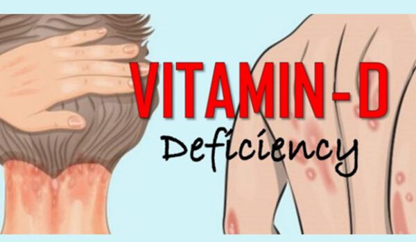 Vitamin D deficiency Symptoms