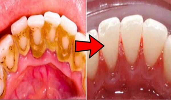How to Remove Plaque from Teeth